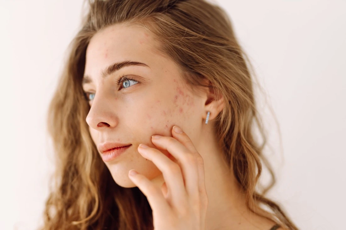 Hyperpigmentation vs Acne Scars: The Difference and How to Treat Each