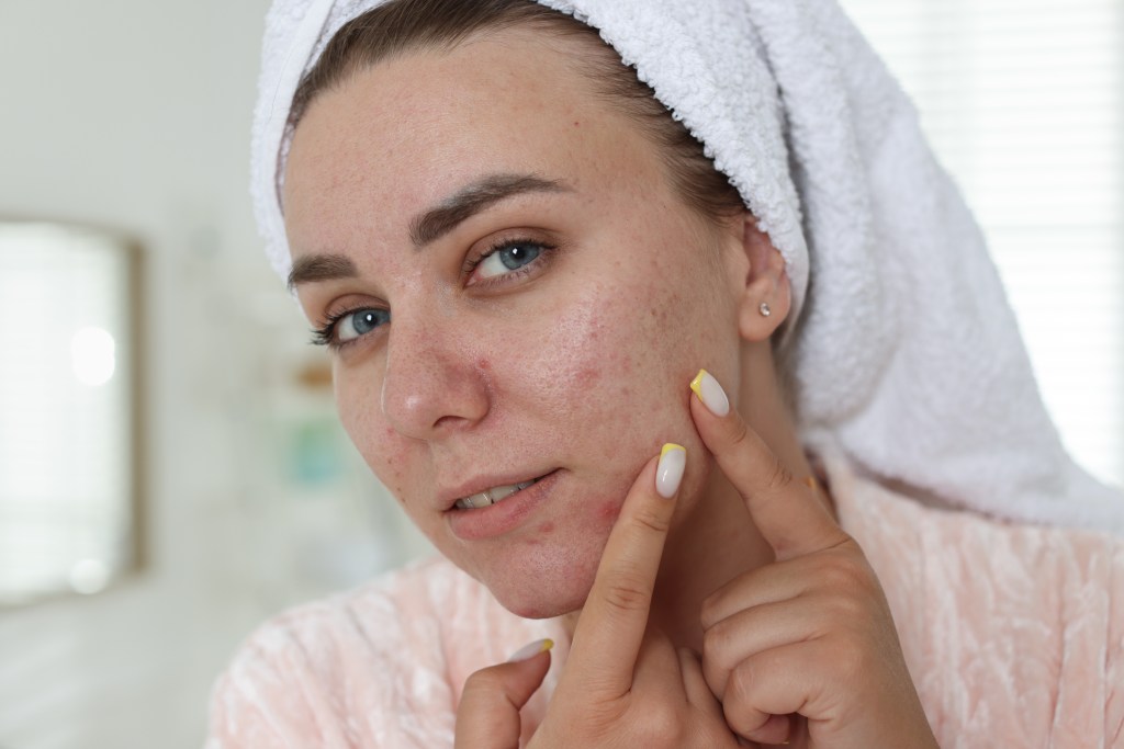 Acne Scars: Changes in the Skin